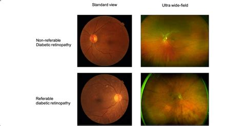 Comparison Of Standard View And Ultra Wide Field Retinal Images With