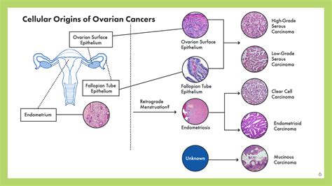 Ovarian Cancers Presentation