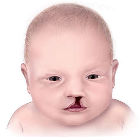 Cleft Palate Cleft Lip Causes Symptoms Repair Surgery