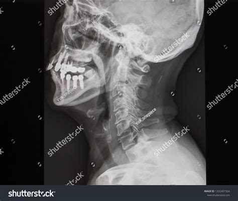 Lateral Radiograph Xray Cervical Spine Showing Foto Stok 1332491504