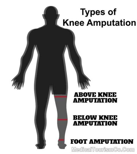 Types Of Knee Amputation