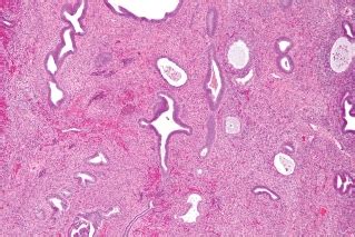 Uterine cancer happens when normal cells in the uterus change into abnormal cells and grow out of control. Uterine polyps during pregnancy | Pregnancy articles ...