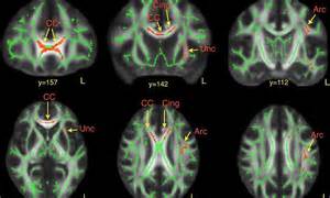 Scans Of Autistic Brains Reveal Differences Involved In Language And