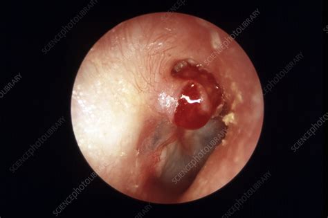 Middle ear infection, otoscope view - Stock Image - M157/0077 - Science
