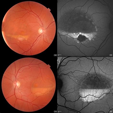 Best Disease Retina Image Bank