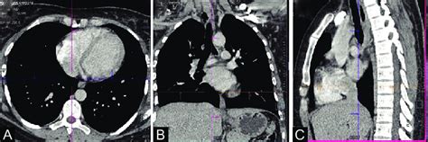 A C A C Contrast Enhanced Ct Chest Routine Axial Coronal And