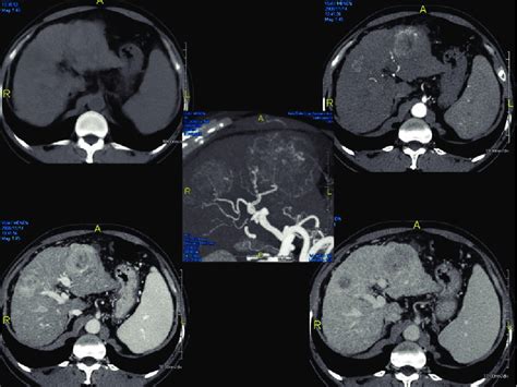Triple Phase Ct Scan Showing Multi Centric Hcc Download Scientific