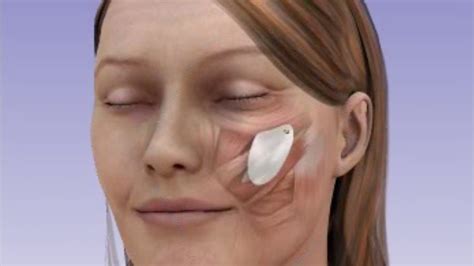 Cheek Implants Or Malar Implants For Cheekbone Enhancement News