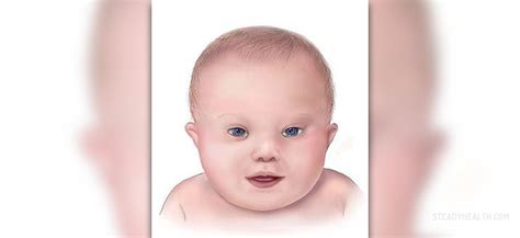 Down syndrome is named after dr. Down syndrome newborn characteristics | Pregnancy articles ...