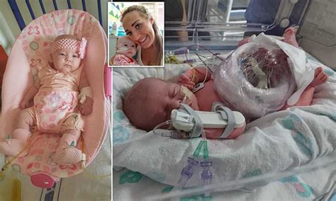 Baby Defied The Odds To Survive After She Was Born With Her Bowel Outside Her Body Daily Mail