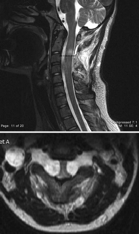 T2 Weighted Sagittal Top And Axial Bottom Mri Of The Upper Cervical