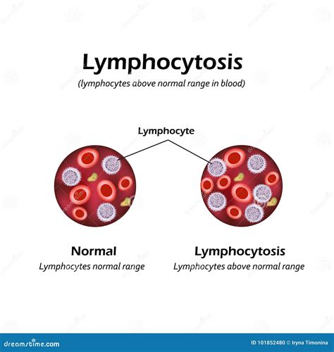 Lymphocytosis Clipart And Illustrations