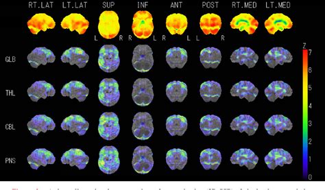 Figure 2 From Temporal Changes In Brain Magnetic Resonance Imaging