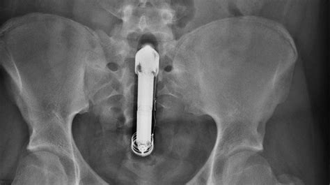 Man Live Tweets Dildo Mishap Complete With X Ray Photo Proof Social