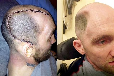 Horrific Pictures Show Man Who Had Skull Caved In After A Single Punch