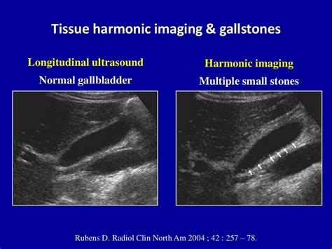 Ultrasound Of The Gallbladder