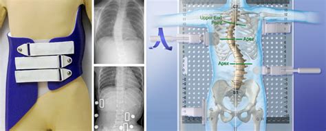 Scoliosis Bracing Systems — Northeast Orthotics And Prosthetics