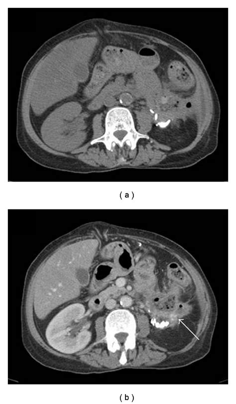 Ct Scan Of The Abdomen And Pelvis A Imaging Without Iv Contrast