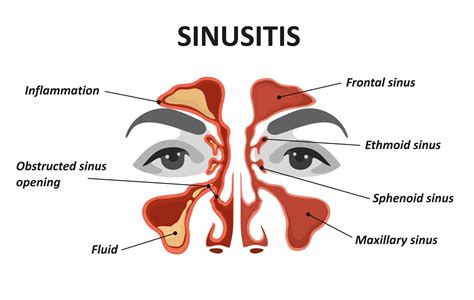 How Your Oral Health Can Affect Your Sinuses