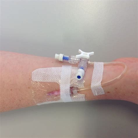 How To Assess A Peripheral Intravenous Iv Cannula
