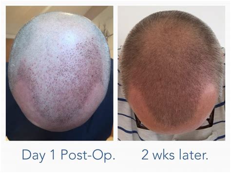 2 Weeks After Hair Transplant Returning To Work Post Op Fue Recovery