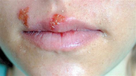 Blisters On Lips