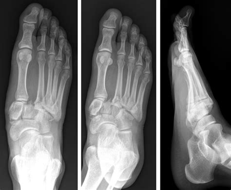 Lisfranc Fracture Dislocation