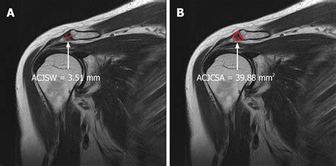 Usefulness Of The Acromioclavicular Joint Cross Sectional Area As A Diagnostic Image Parameter