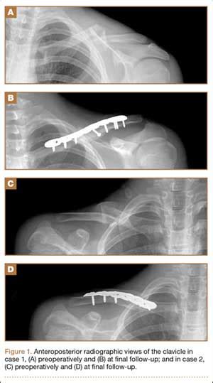 Is Skin Tenting Secondary To Displaced Clavicle Fracture More Than A