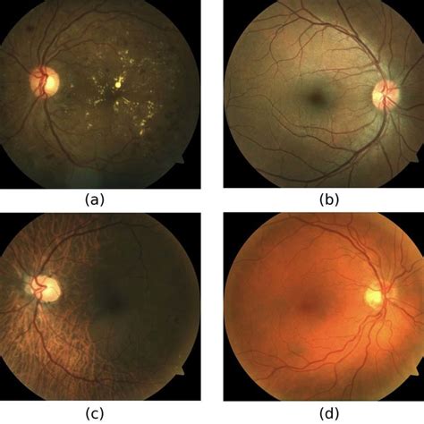 Examples Of Fundus Images In Our Dataset A African American Patients