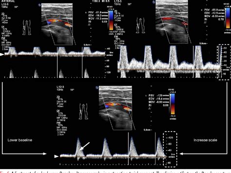 Figure 3 From Doppler Ultrasonography Of The Lower Extremity Arteries