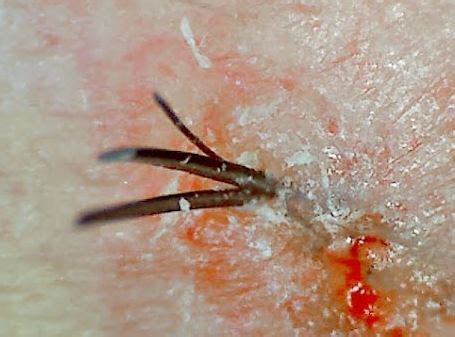 Keep reading to find out 14 important facts about your pubic hair! Multiple/Two Hairs One Follicle on Scalp, Armpit, Pubic ...