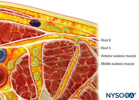 Ultrasound Guided Interscalene Brachial Plexus Block Nysora