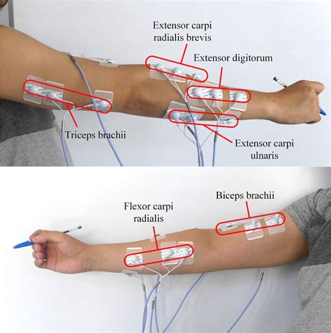 The pronator teres muscle forms the medial border of the cubital fossa in the anterior elbow. Electrode placement over the forearm and upper arm muscles ...