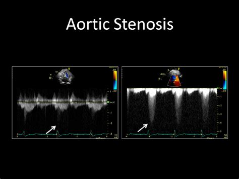 Continuous Wave Spectral Doppler Display Of A Patient With Aortic