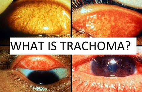Mbbs Doctors Trachoma Signs And Symptoms Diagnosis Treatment