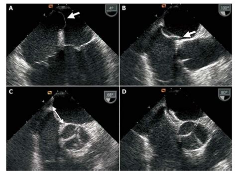 Percutaneous Closure Of Patent Foramen Ovale In Young Patients With