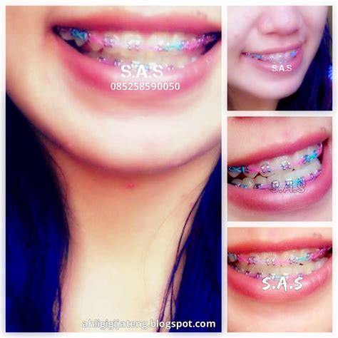 Check spelling or type a new query. Foto Senyum Cewek Berbehel / Berkawat Gigi Cantik :) | S.A ...