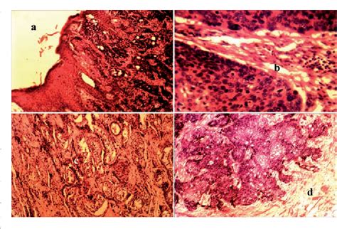 Figure 1 From Squamous Cell Carcinoma Of The Scrotum In A Nigerian Case Report Semantic Scholar