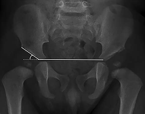 Measuring The Acetabular Index An Accurate And Reliable Alternative