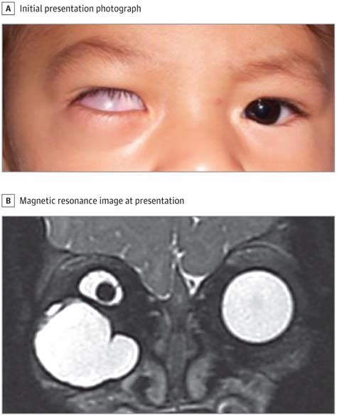 Hidden Globe In An Infant Congenital Defects Jama Ophthalmology