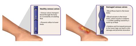 Treatment Venous Leg Ulcers Symptoms Causes And Cleaning Absorbest