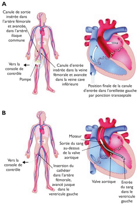 Assistances Ventriculaires Gauches Dans Le Choc Cardiog Ne Et L