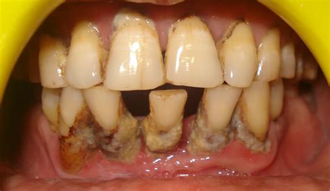 necrotizing periodontal disease
