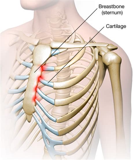 The sternum is comprised of three distinctive portions: Costochondritis - Causes, Symptoms, Locations, Duration ...