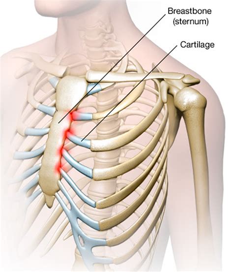 The chest diameter is smaller in comparison to the abdomen. Costochondritis - Causes, Symptoms, Locations, Duration ...