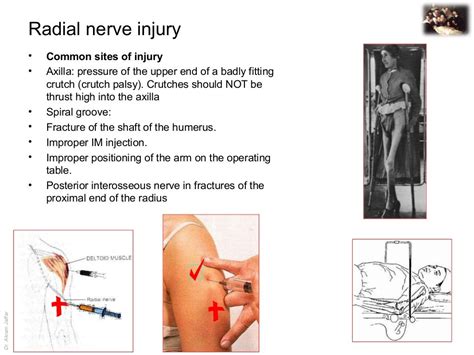 Applied Anatomy Radial Nerve Injury