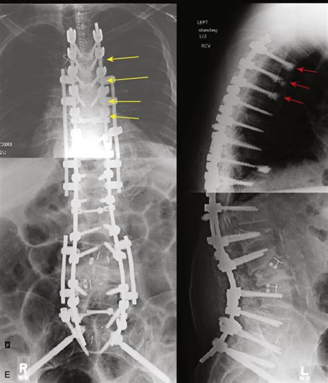 Interbody Fusion Strategies In Thoracic And Sacral Overlap Diseases