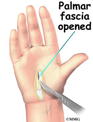 Blisters develop on the face, neck, and hands of those who have it. Patient Education | Concord Orthopaedics