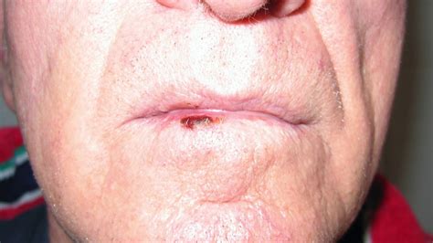 Skin Cancer Lower Lip